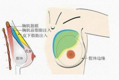 復(fù)合隆胸脂肪存活率高嗎？一般可以維持多長(zhǎng)時(shí)間呢？