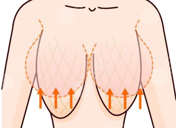 乳房下垂
