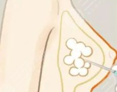 乳房下垂矯正有哪些方法？矯正術(shù)后能不能吃辛辣的食物呢？