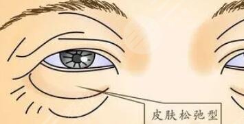 去眼袋