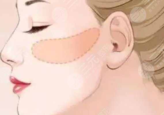 顴骨磨骨
