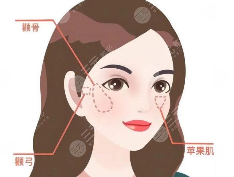 顴骨整形