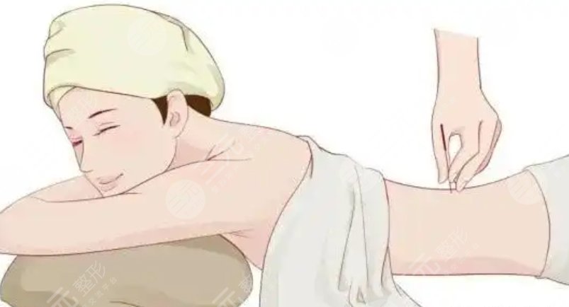 埋線減肥