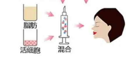 脂肪填充