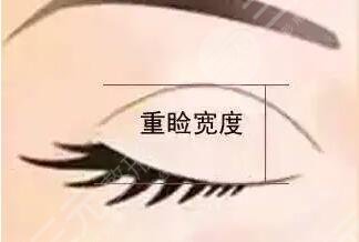 雙眼皮