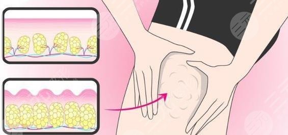 吸脂