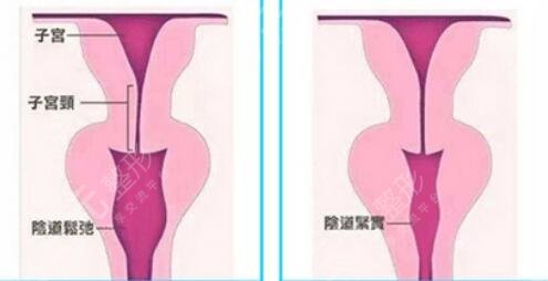 私密緊縮