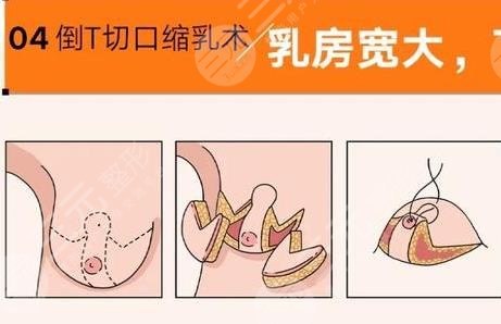 雙眼皮