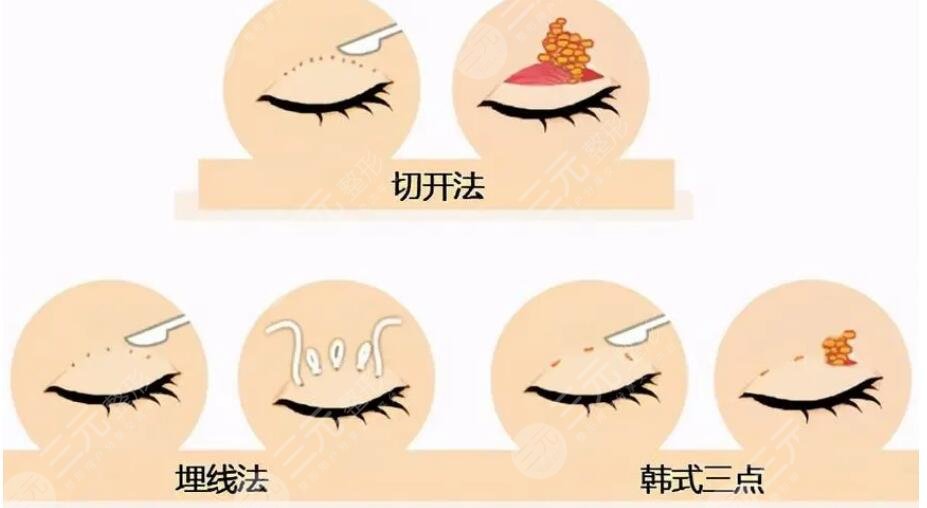 雙眼皮修復(fù)