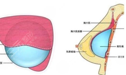 隆胸