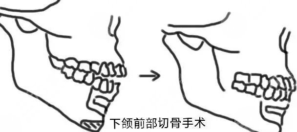 正頜手術(shù)