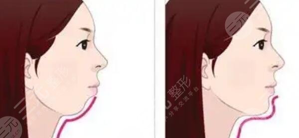 豐下巴