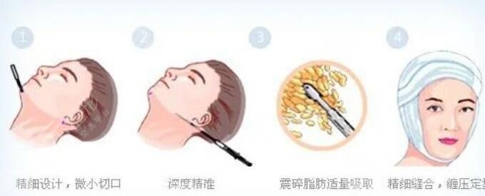 雙下巴