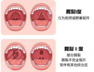 腭裂修復(fù)動(dòng)漫