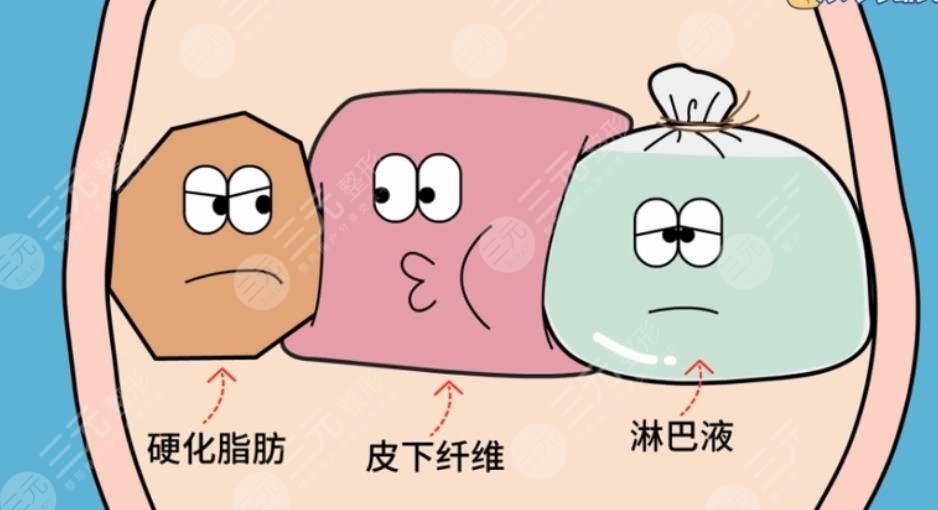 吸脂手術(shù)