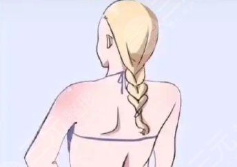 大腿吸脂