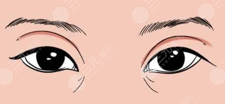 雙眼皮