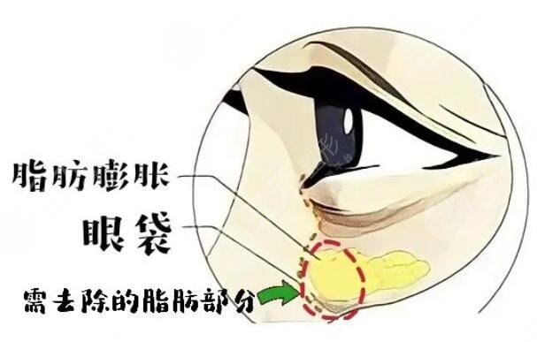 眼袋