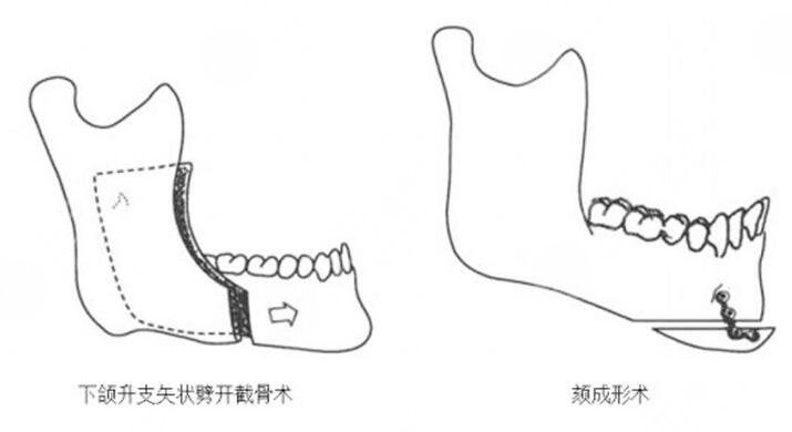頦成型