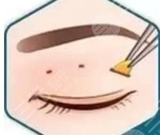 雙眼皮