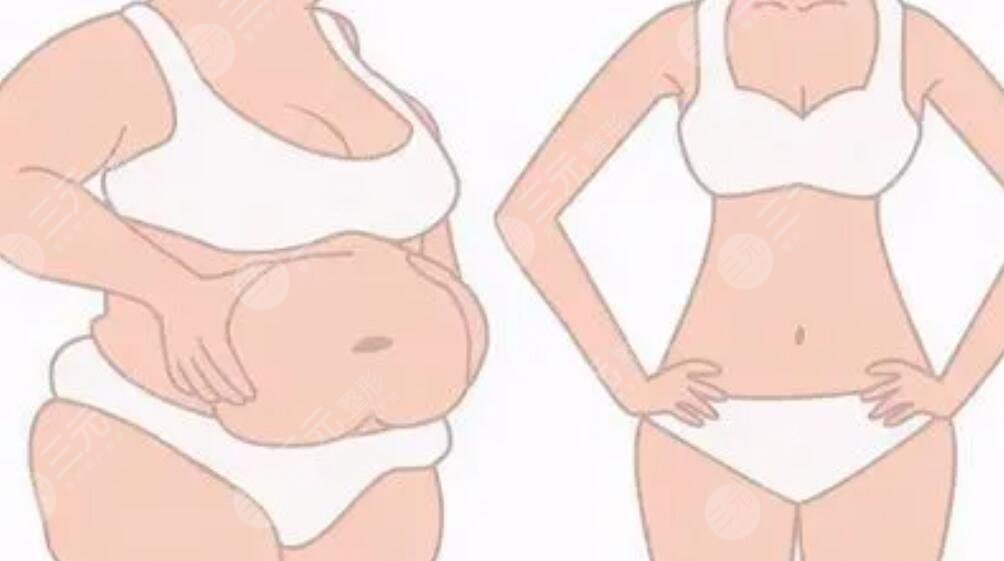 腹壁整形