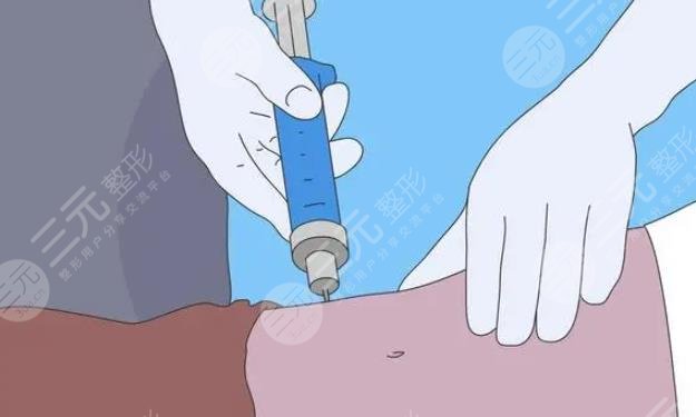 吸脂手術