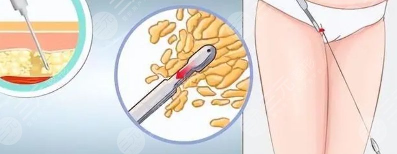 大腿吸脂