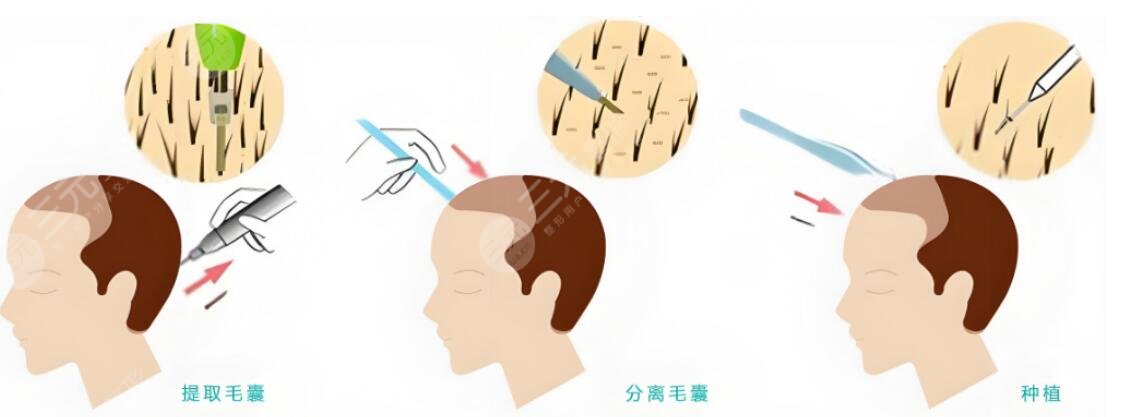 植發(fā)