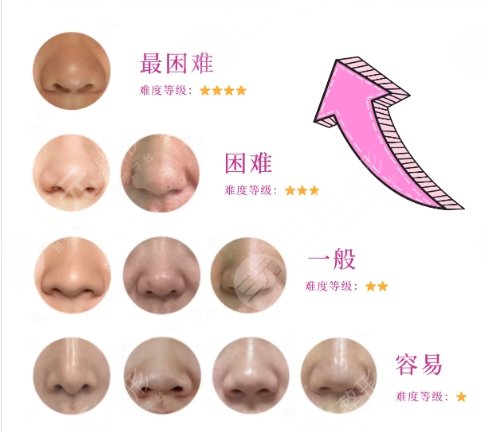 隆鼻