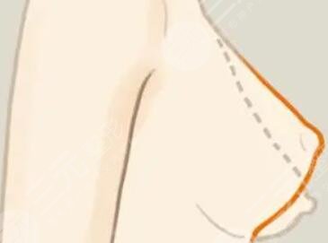 乳房懸吊