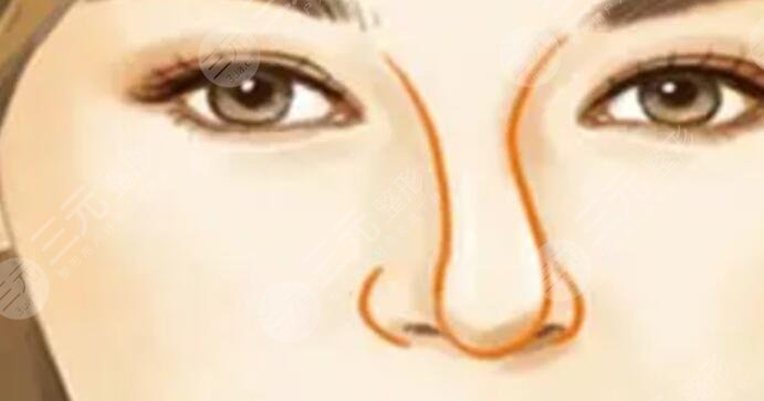 歪鼻矯正