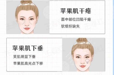 蘋果肌