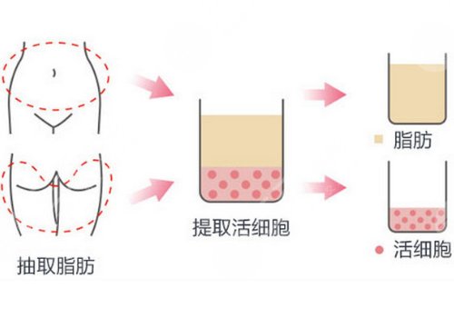 彭義坤和包濤哪個(gè)假體隆胸厲害？那個(gè)手感更真實(shí)？實(shí)力醫(yī)生PK