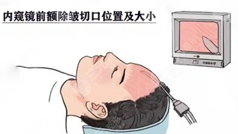 除皺