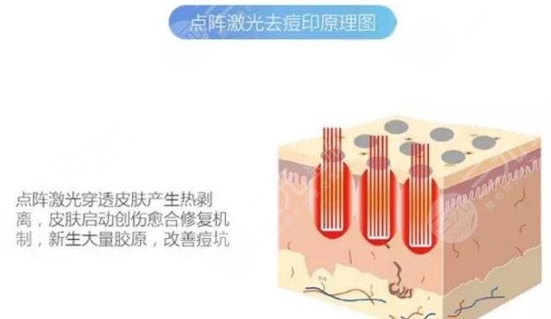 點(diǎn)陣激光