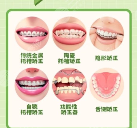 牙齒矯正