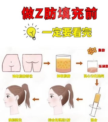 脂肪填充