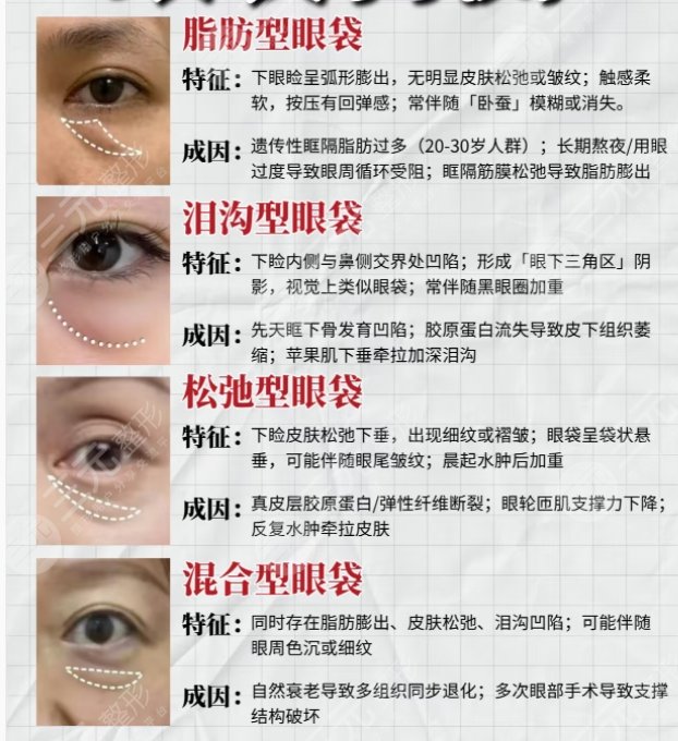 眼袋