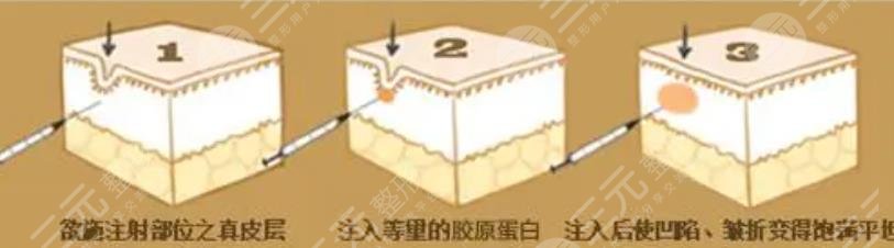 除皺