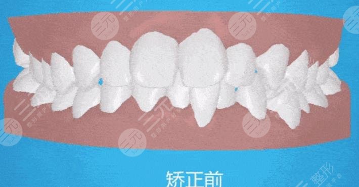 牙齒矯正
