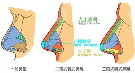 隆鼻隆鼻
